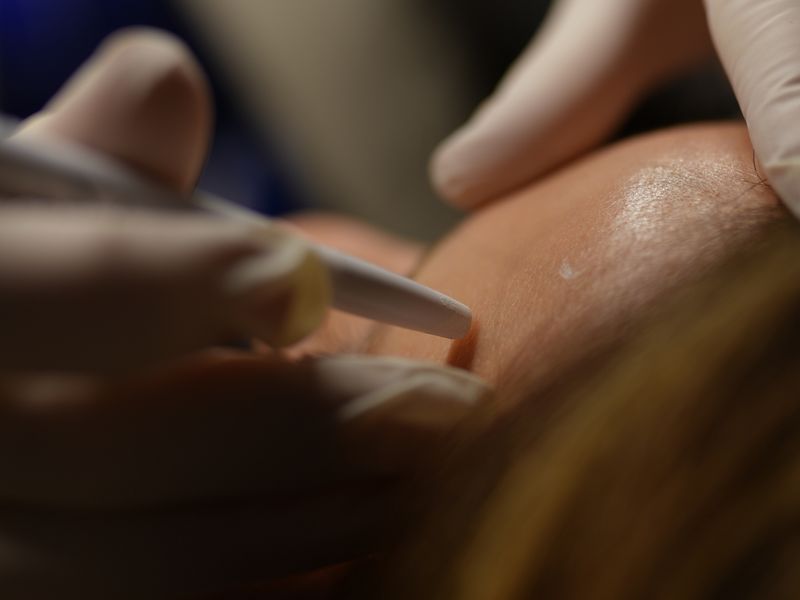 Chemical Peel